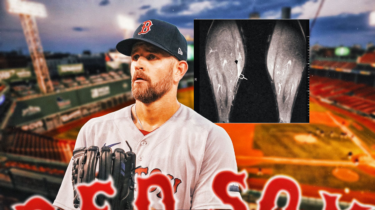 Red Sox's James Paxton looking worried with a diagram of a calf injury beside him